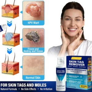 CVREOZ® TagRecede Cryo Treatment Spray