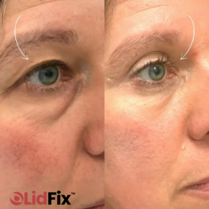 LidFix™ Eye Cream | Instantly lift your eyelids without Botox 7 LidFix™ Eye Cream | Instantly lift your eyelids without Botox