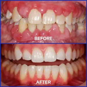 Alisanda® Bee Venom Dental Treatment Toothpaste