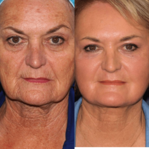 Elyra™ | Remove 98% of your wrinkles and look 15 years younger in just 7 days