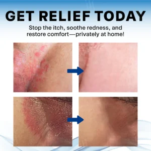 Alisanda® Scrotum Itchy Treatment Cream 10 Alisanda® Scrotum Itchy Treatment Cream