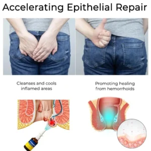 YUNPSO® Herbal Hemorrhoid Treatment Anal Spray Pro 10 YUNPSO® Herbal Hemorrhoid Treatment Anal Spray Pro